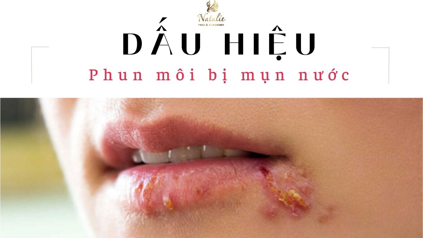 2 Dấu Hiệu Phun Môi Bị Mụn Nước Chưa Chắc Bạn Đã Biết?